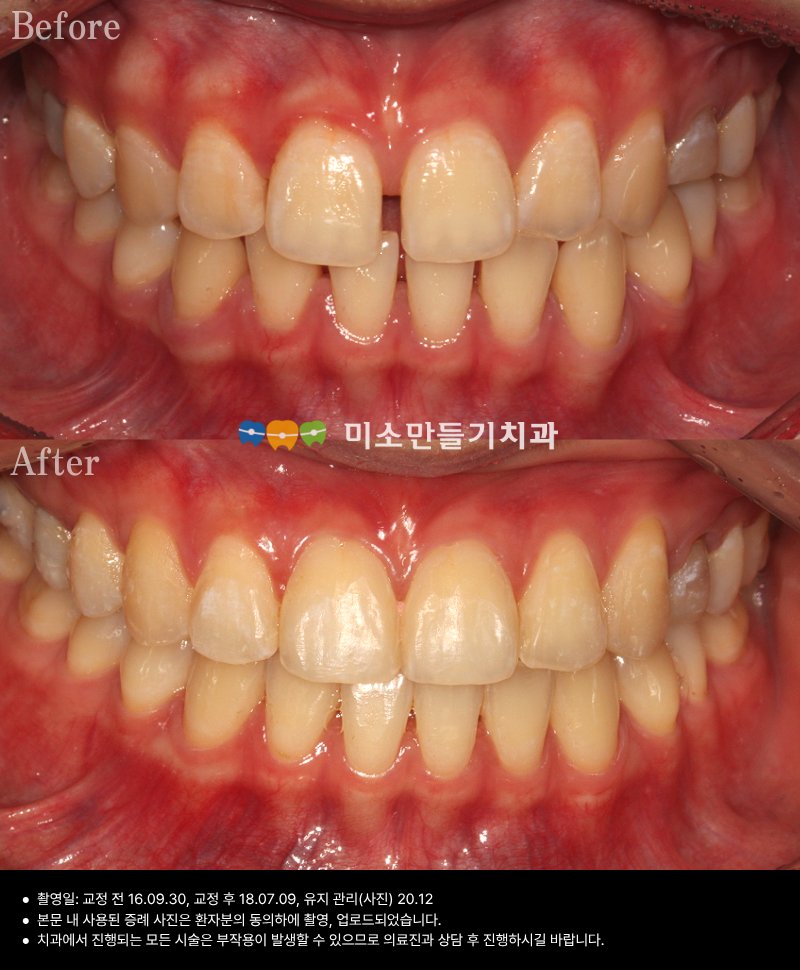교정 치료 사례 치료 전후