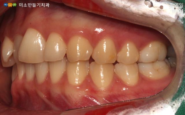 앞니만 교정할 수 있나요? 관련 사진 3