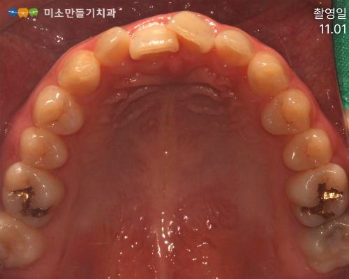 앞니만 교정할 수 있나요? 관련 사진 4