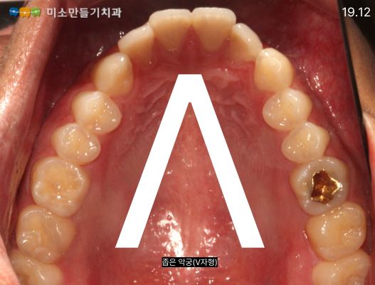좁은 악궁