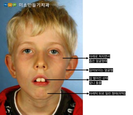 아데노이드형 얼굴의 특징