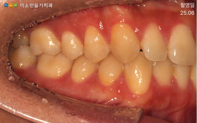 경미한 총생, 방법은 두 가지입니다 관련 사진 1