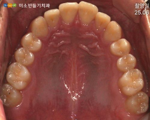 경미한 총생, 방법은 두 가지입니다 관련 사진 4