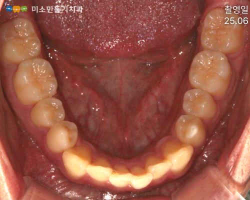 경미한 총생, 방법은 두 가지입니다 관련 사진 5