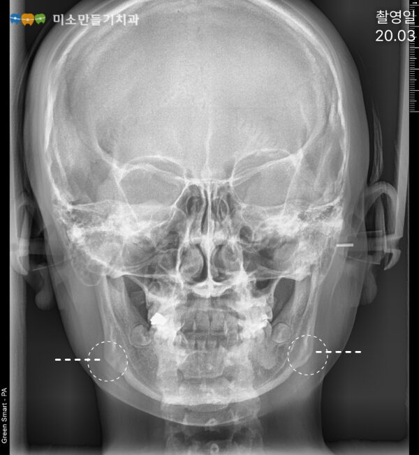 정면 두부 X-ray 촬영 영상으로 좌우 턱뼈의 형태와 위치를 확인할 수 있는 모습