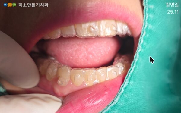 인비절라인 투명교정 장치를 착용한 구강 내부 모습